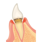 歯周病の進行と治療