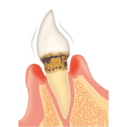 歯周病の進行と治療