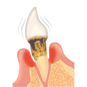 歯周病の進行と治療